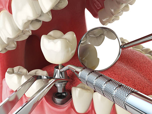 Best Emergency Tooth Extraction in Hartsville, TN